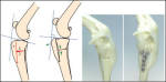 tibialcrossew2.th tibialcrossew2.th